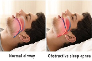 Obstructive Sleep Apnea