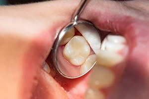 A dental mirror reflecting a tooth-colored filling.