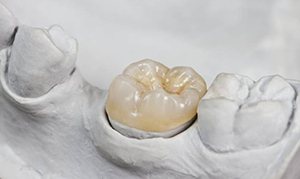 A porcelain crown sitting inside a dental mold.