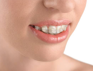 Closeup of teeth with Six Month Smiles Braces